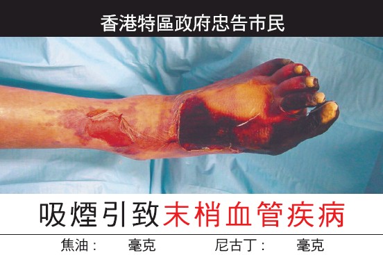 Hong Kong 2007 Health Effects vascular system - diseased organ, peripheral vascular disease, foot, gross, chinese